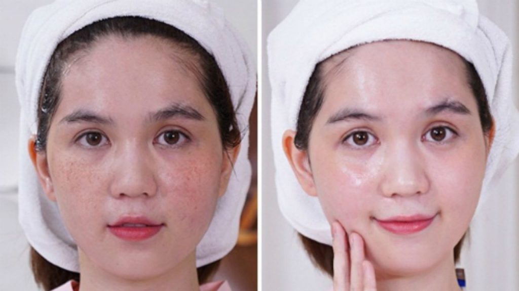 bắn laser điều trị nám và những lưu ý cho chị em