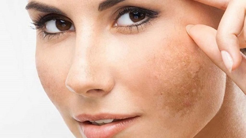 phương pháp trị nám với máy laser