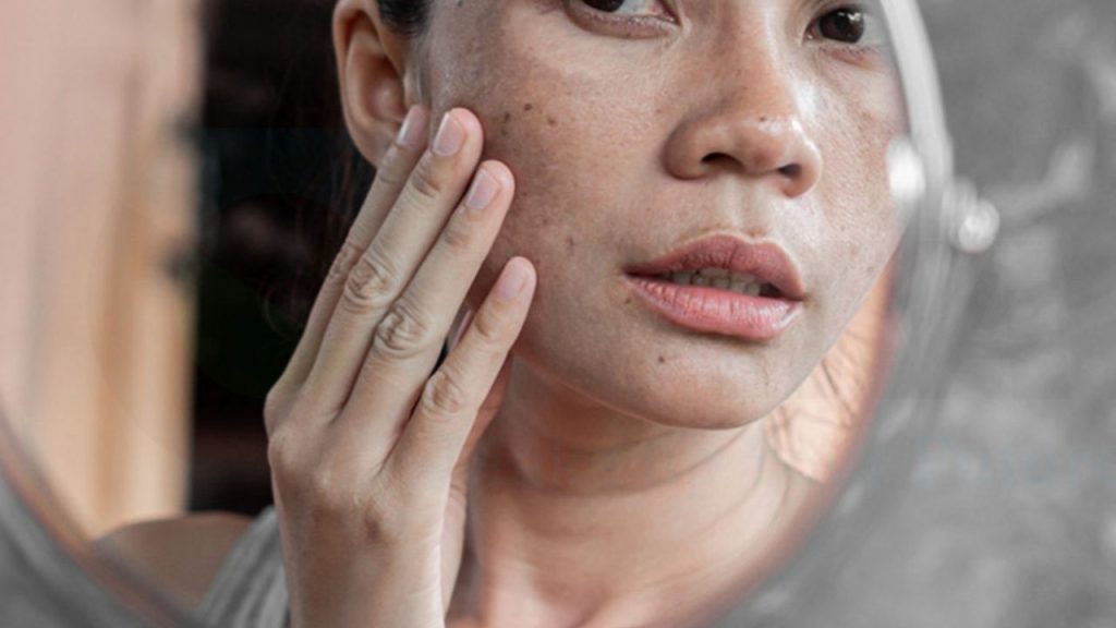 phương pháp trị nám hiệu quả khi được xử lý đúng cách