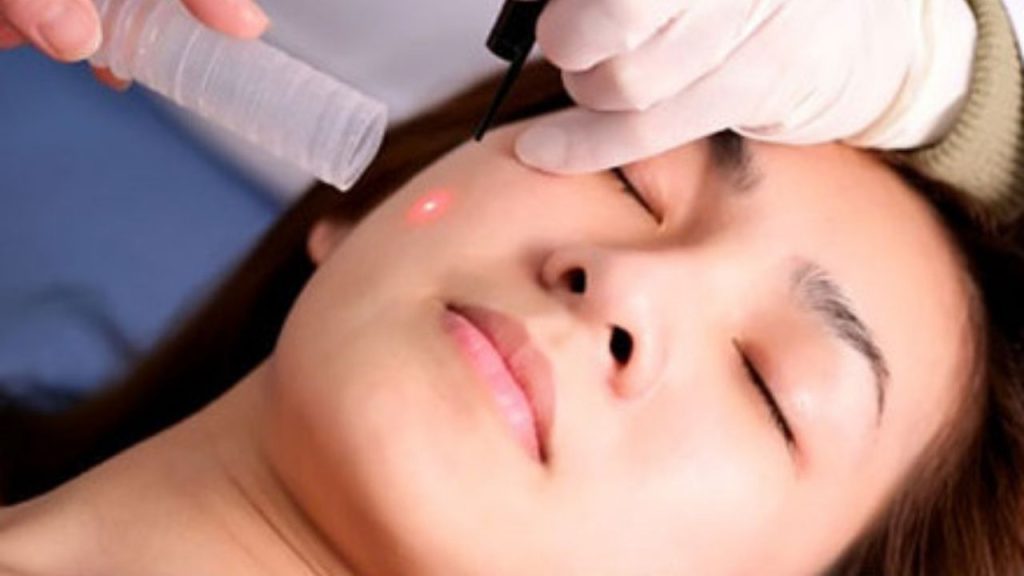 sử dung laser trị nám có an toàn và hiệu quả không