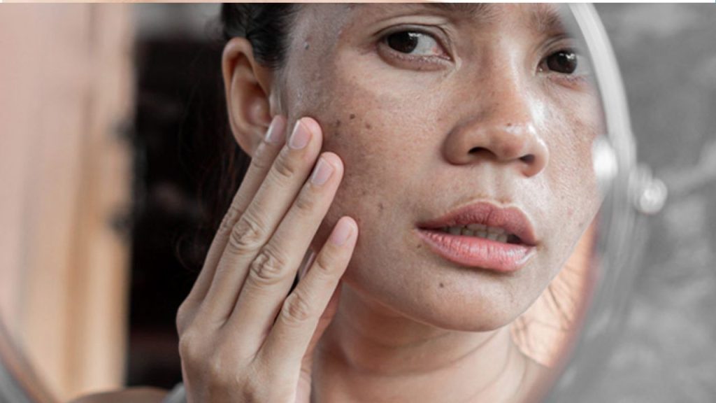 điều trị nám da có hiệu quả cao với laser