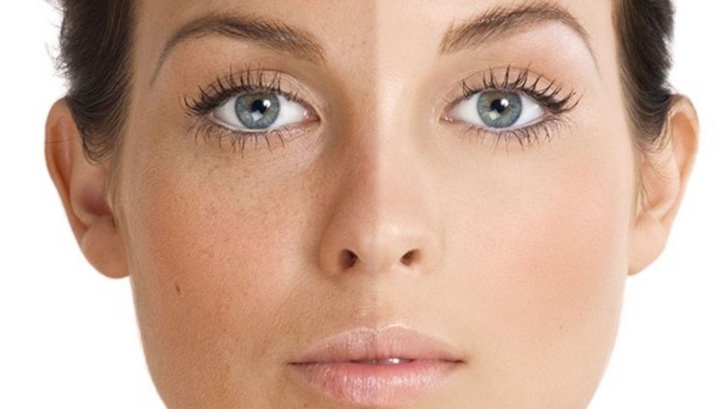 8 phương pháp điều trị sắc tố da hiệu quả