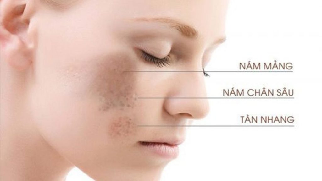 Nguyên nhân gây tăng sắc tố da