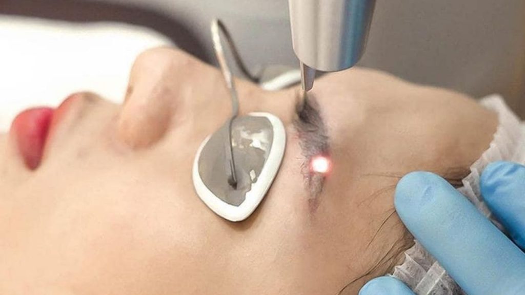 Máy xoá xăm laser mini