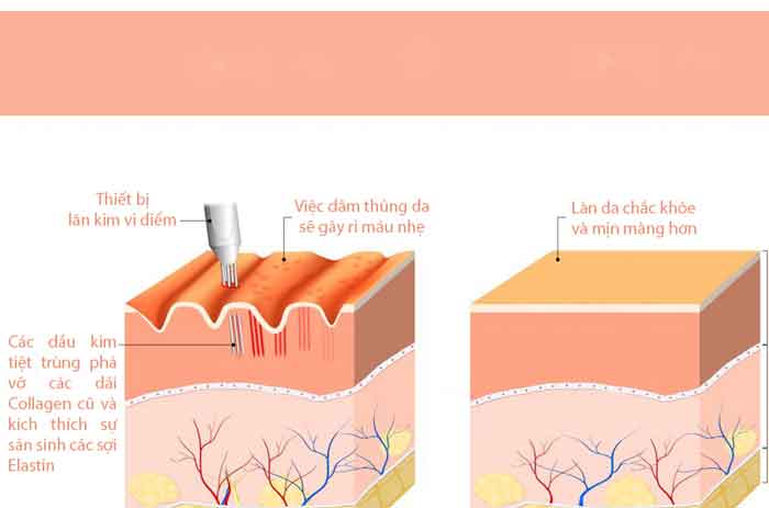 Vi kim điện từ là phương pháp kích thích khả năng tự sản sinh collagen của da