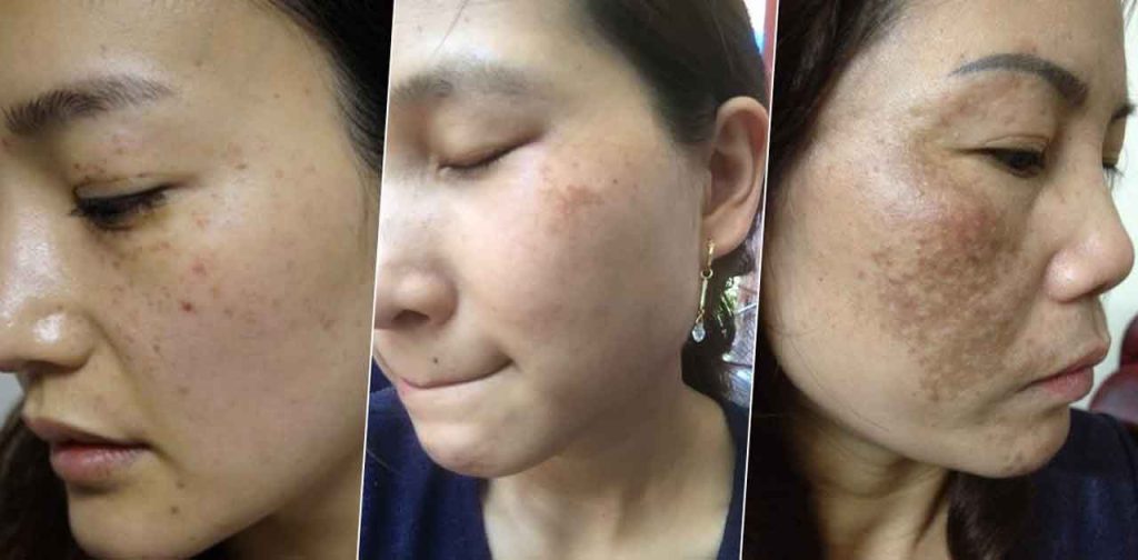 Bắn laser điệu trị nám có thực sự đem lại hiệu quả