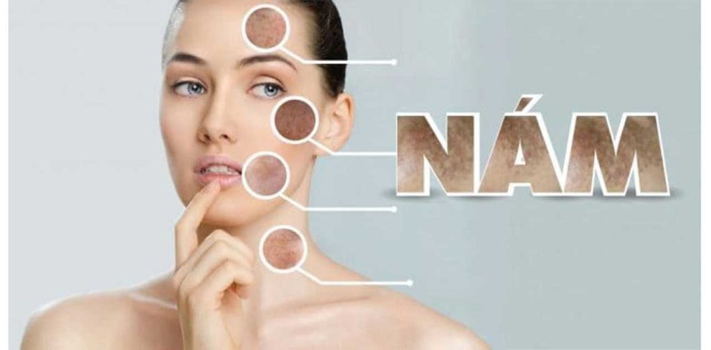 Bắn laser trị nám giá bao nhiêu, cơ sở nào uy tín