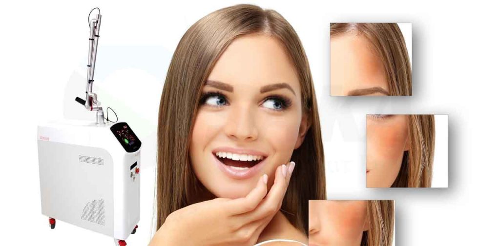 Bắn laser trị nám là gì, có loại bỏ được nám không