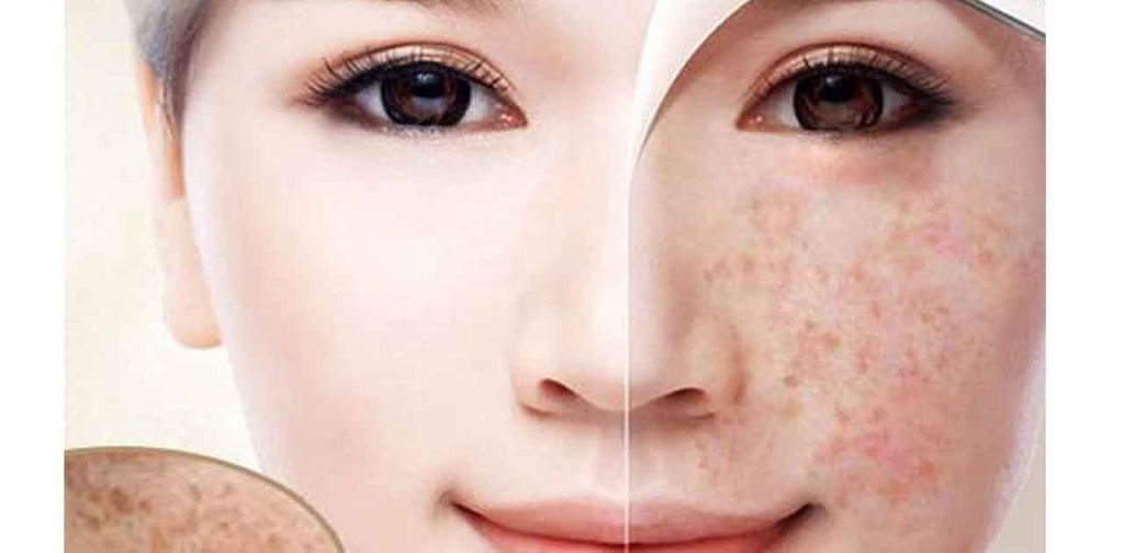 Bắn laser tri nám tàn nhang hiệu quả thần tốc