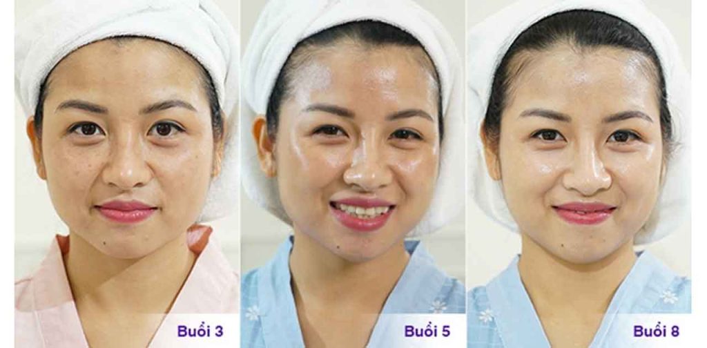 Có nên bắn laser trị nám hay không, bắn laser trị nám có ảnh hưởng gì