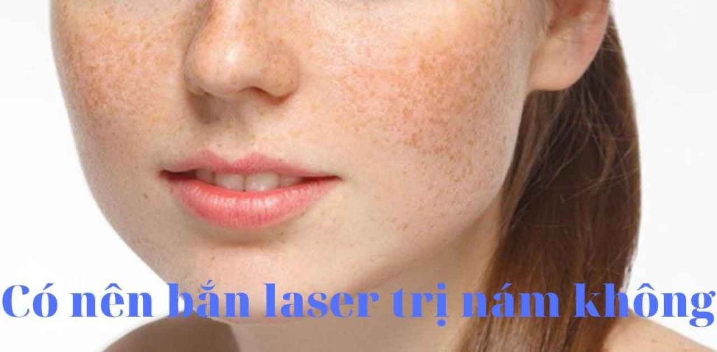 Có nên bắn laser trị nám không. phương pháp nào hiệu quả