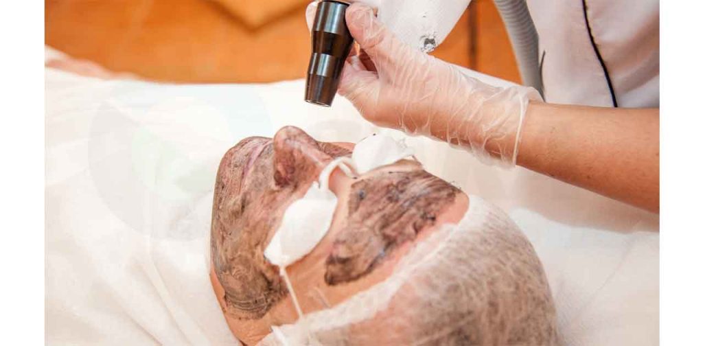 Phương pháp laser trị nám da giá rẻ cho chị em