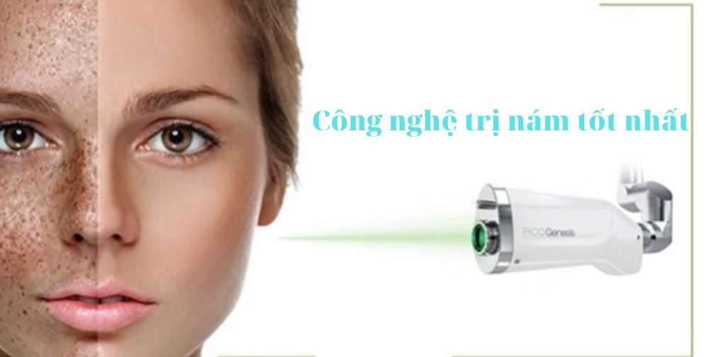 Top các công nghệ trị nám tốt nhất hiện nay