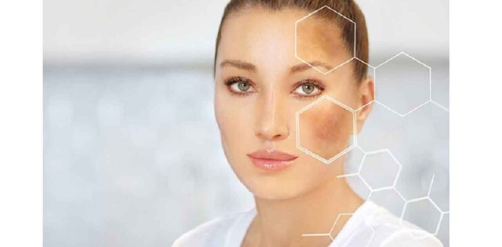 Quy trình laser trị nám tại spa, thẩm mỹ viện