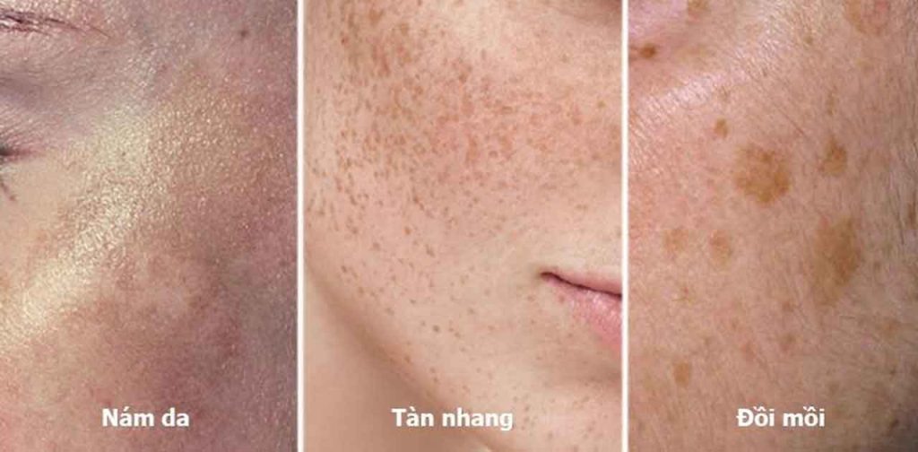 Laser trị nám tàn nhang dành cho chị em