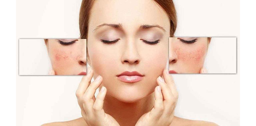 Các loại kem trị tàn nhang đồi môi hiệu quả