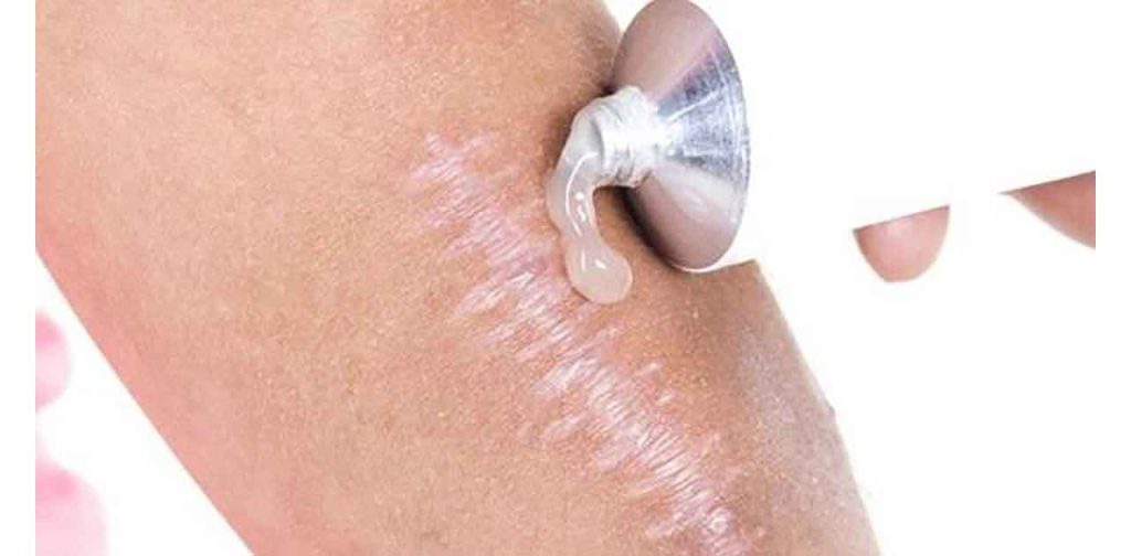 Cách bôi thuốc trị sẹo an toàn