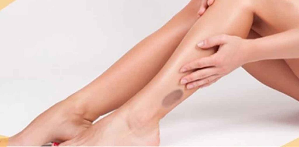 Cách trị sẹo bỏng bô đơn giản tại nhà