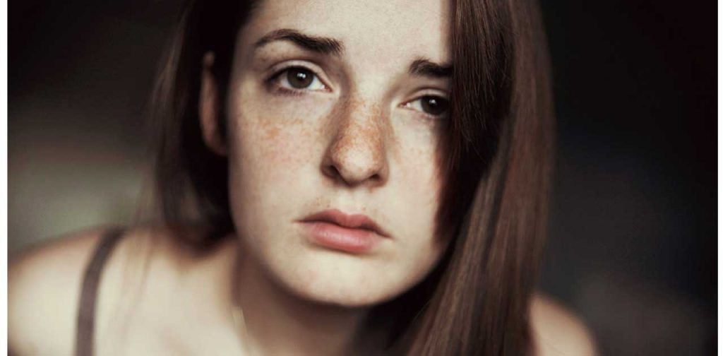 3 Cách trị tàn nhang bẩm sinh cơ bản