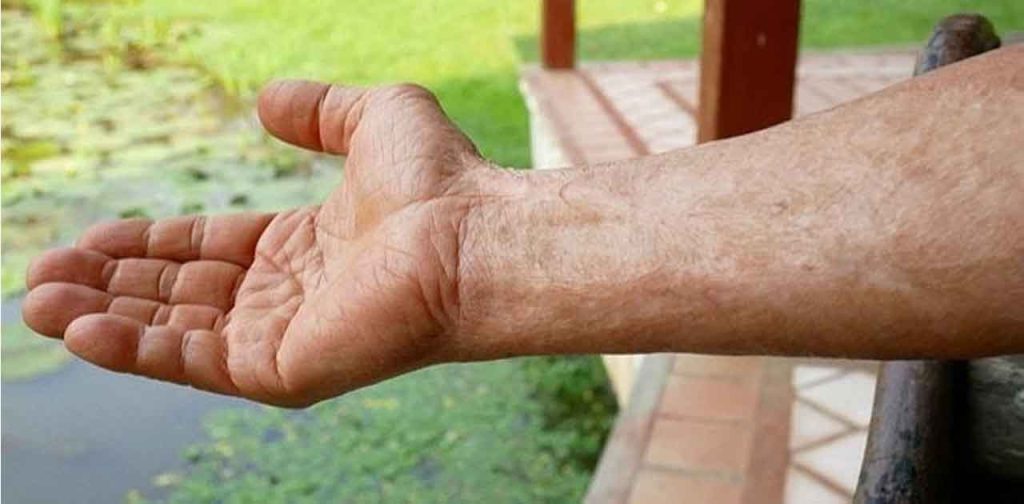 Máy trị sẹo bỏng tiên tiến nhất hiện nay