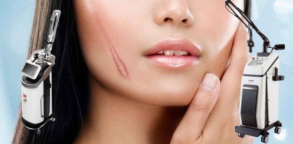 máy laser điều trị sẹo an toàn hiệu quả cao