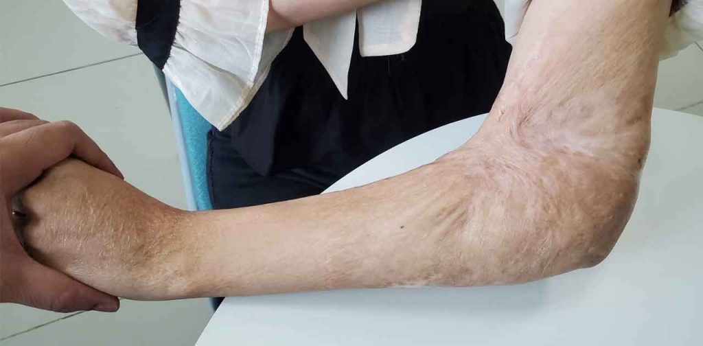 Mua máy trị sẹo bỏng nước sôi ở đâu