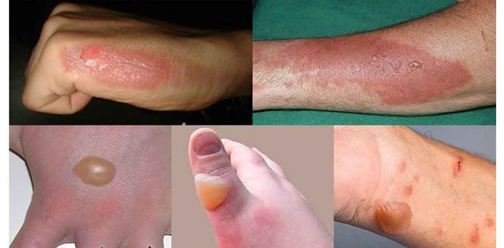 Dòng máy trị sẹo bỏng nước sôi lâu năm