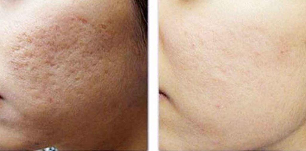 Các thiết bị trị sẹo tốt nhất hiện nay