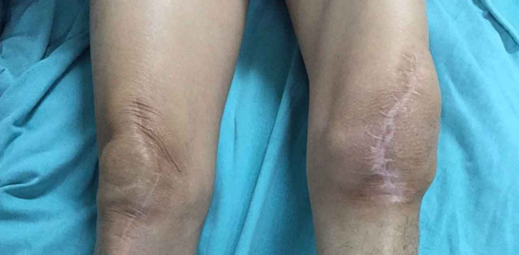 3 Máy trị sẹo đầu gối tốt nhất hiện nay