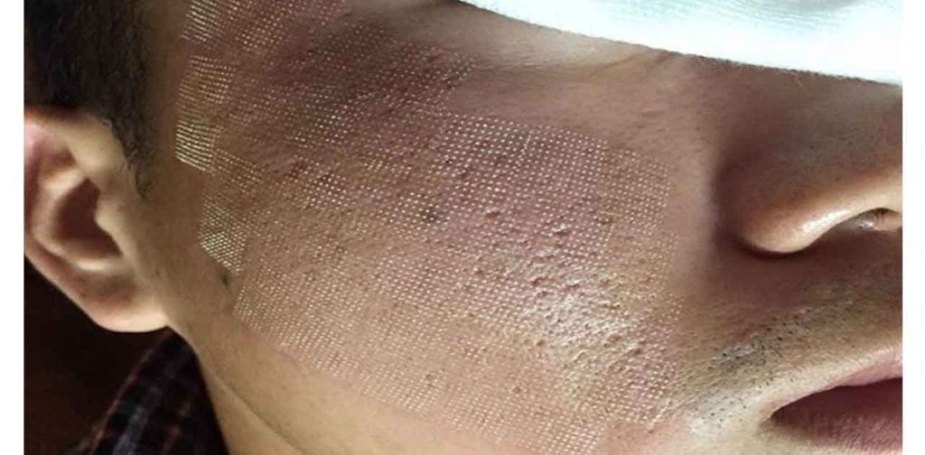 Thiết bị chuyên dụng trị sẹo đáy nhọn