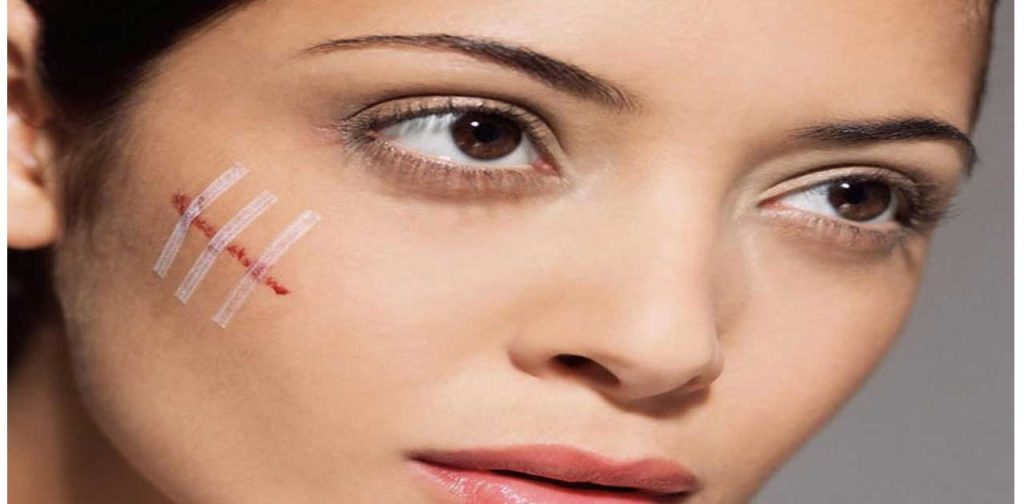 Máy trị sẹo khâu trên mặt hiệu quả cao nhất