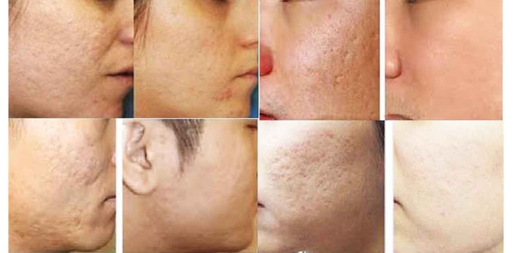 Các dòng máy trị sẹo lâu năm hiệu quả