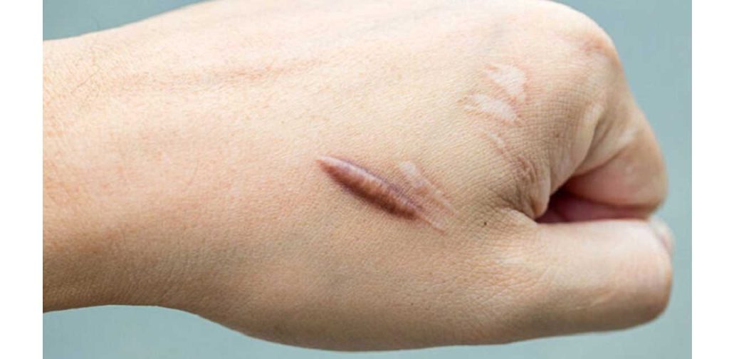 Thiết bị trị sẹo lồi hiệu quả