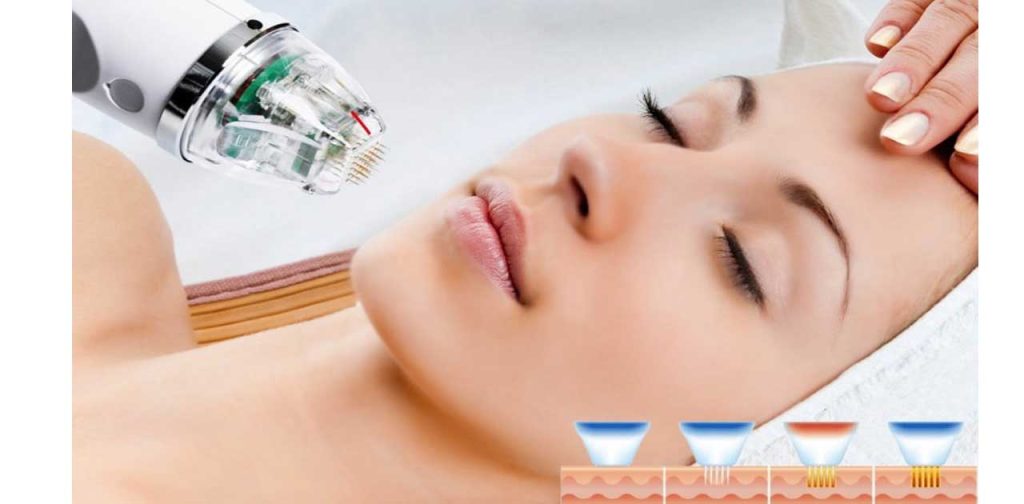 Các thiết bị trị sẹo mini cầm tay hiệu quả nhất