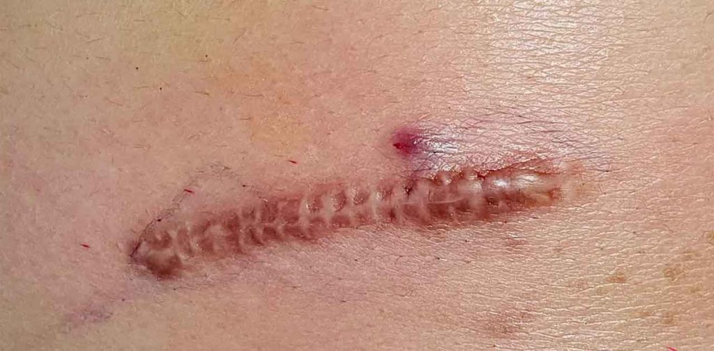 Các thiết bị trị sẹo sau phẫu thuật an toàn