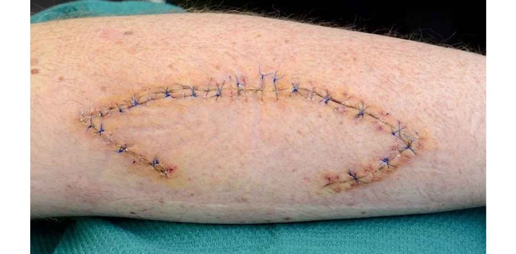 Máy trị sẹo sau cắt chỉ phẫu thuật cao cấp