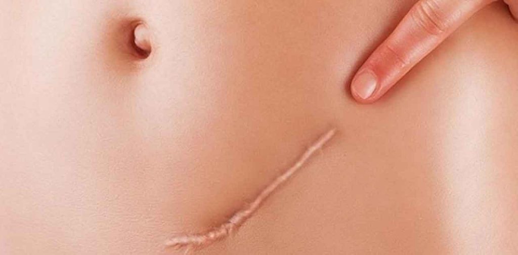 Thiết bị trị sẹo phẫu thuật giá rẻ