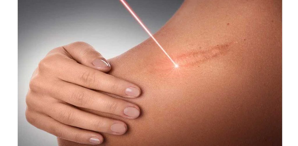 Các mẫu máy trị sẹo thâm hiệu quả nhất