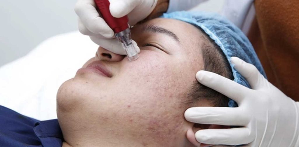 Các phương pháp trị sẹo lõm do mụn hiệu quả nhất