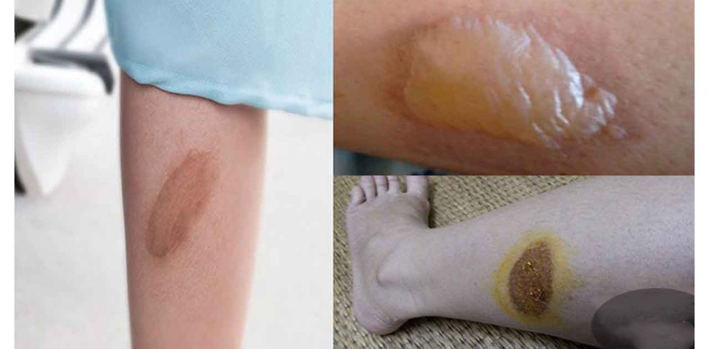 Cách trị sẹo bỏng bô xe máy an toàn nhanh khỏi