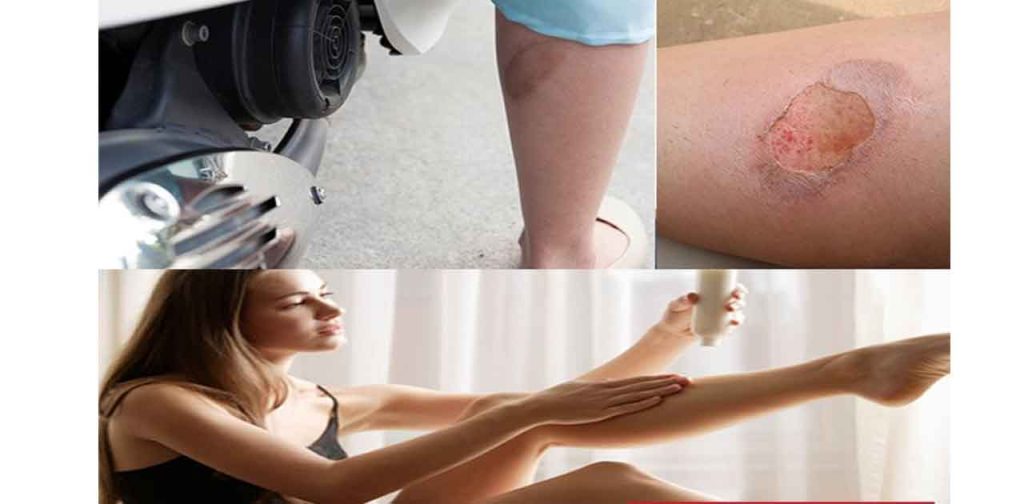 Cách trị sẹo bỏng bô cơ bản