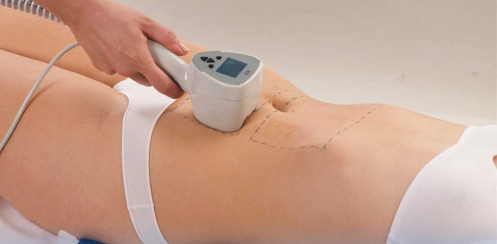 Chia sẻ các công nghệ hút mỡ hiệu quả