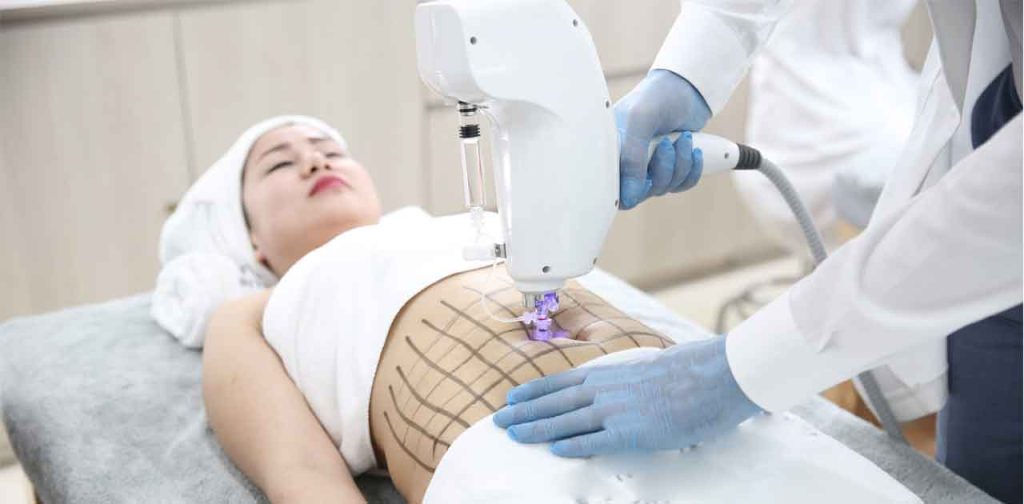 Giảm mỡ công nghệ cao không xâm lấn