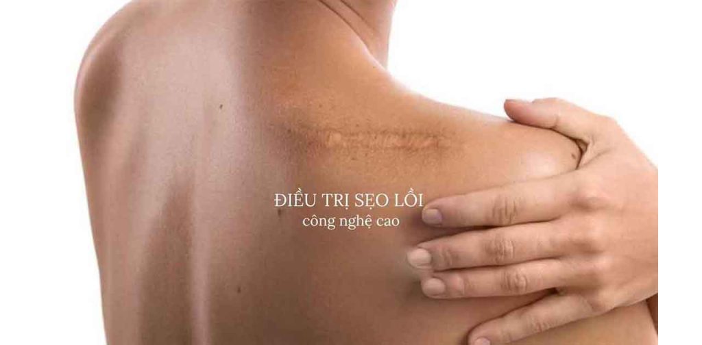 Các dòng máy trị sẹo lồi tiên tiến nhất