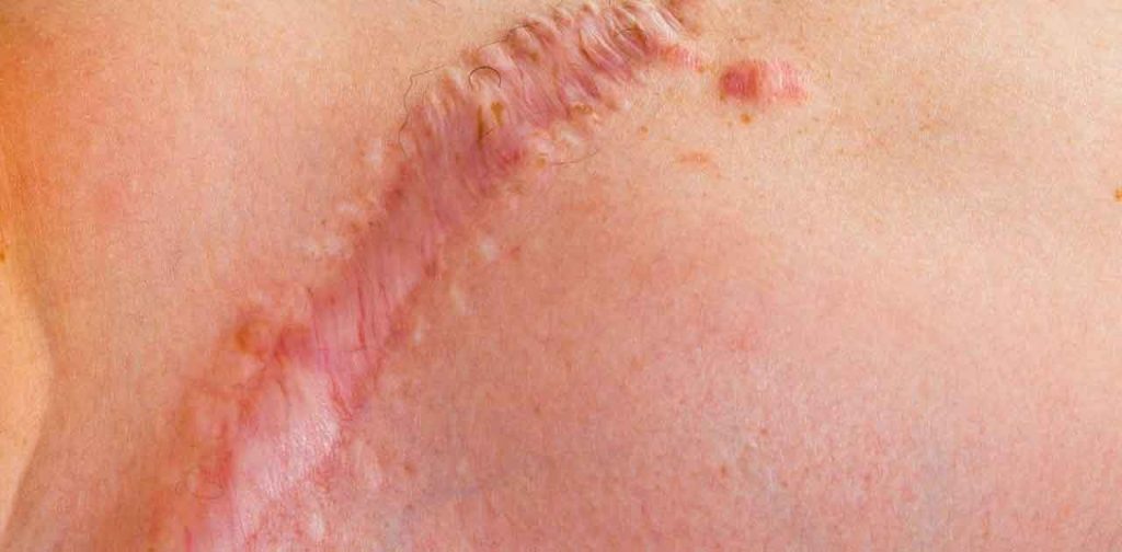 Các dòng máy trị sẹo đỏ giá rẻ ngay tại nhà