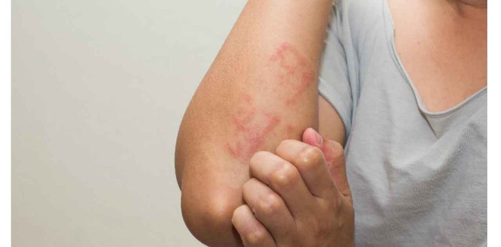 Các loại máy trị sẹo lâu năm hiệu quả