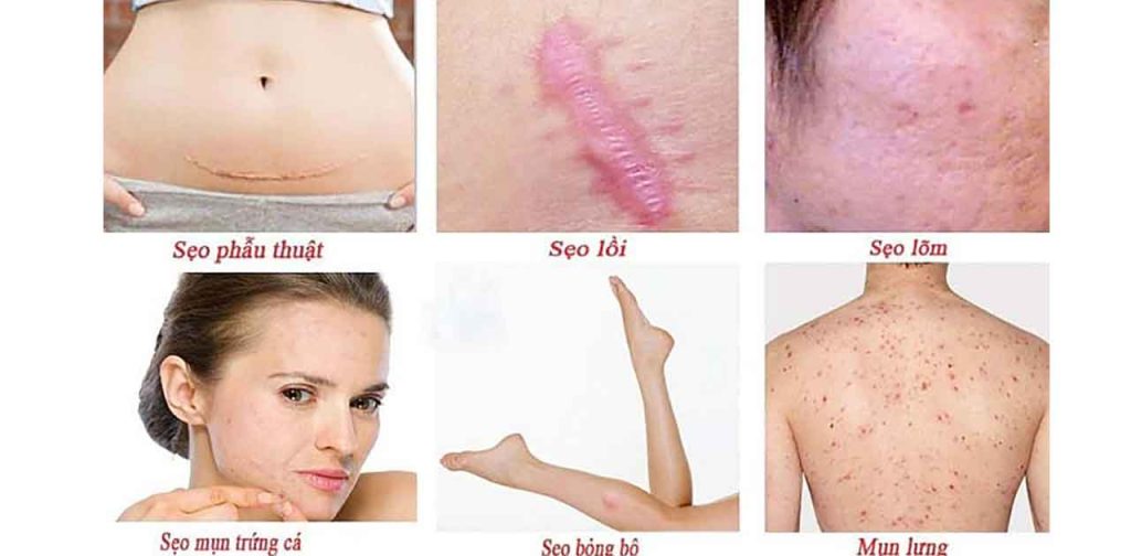 Các dòng máy trị sẹo tại thẩm mỹ viên kangnam