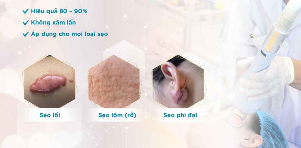 Các dòng máy trị sẹo lồi lâu năm giá rẻ