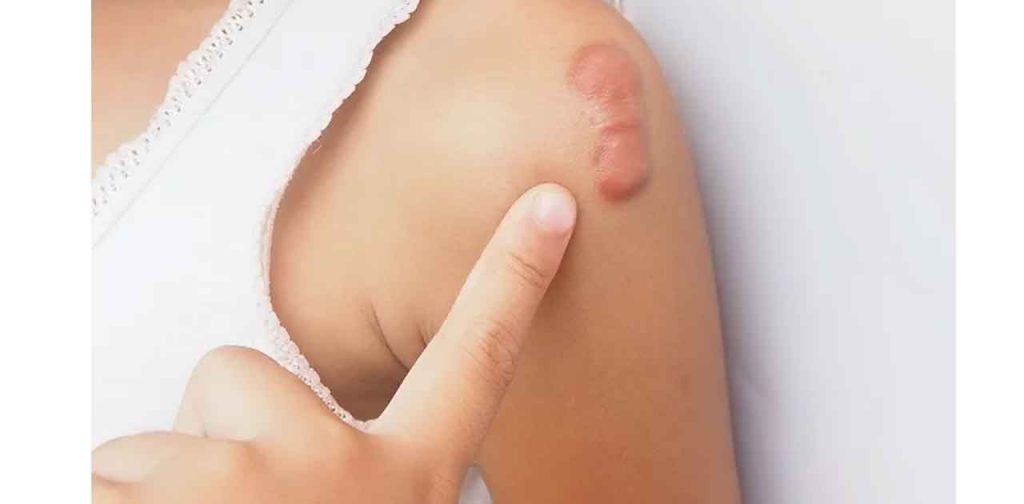 Máy trị sẹo lồi ngay tại nhà hiệu quả