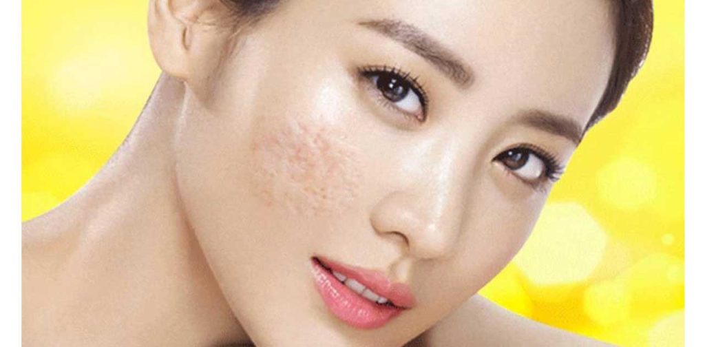 Máy trị sẹo lõm tại nhà giá rẻ